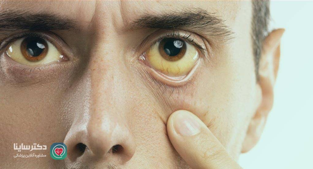 هپاتیت A چیست؟