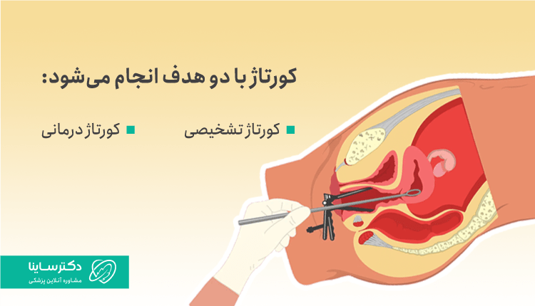 انواع کورتاژ