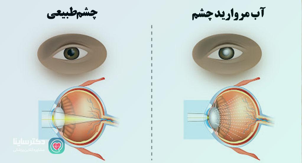 آب مروارید چشم