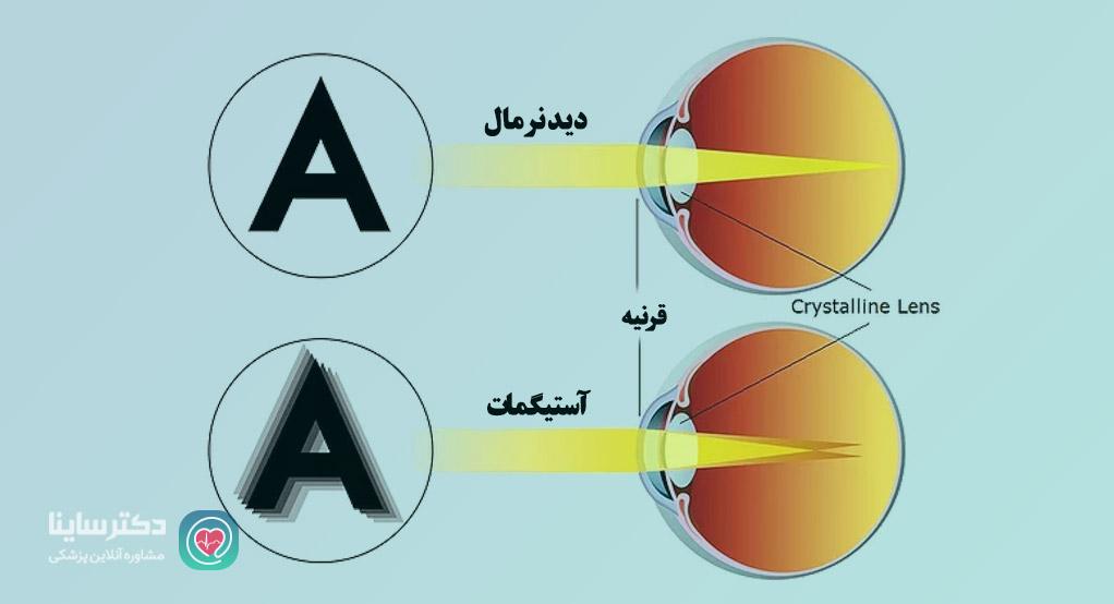 آستیگمات چیست