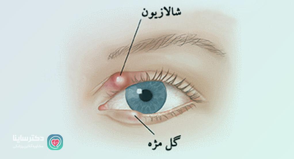 تفاوت گل مژه و شالازیون