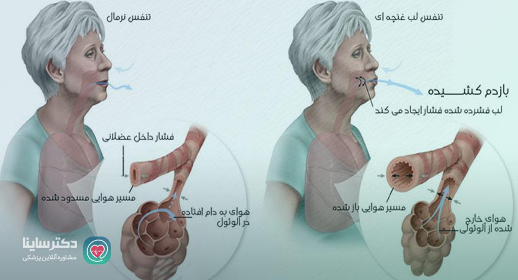 جدیدترین روش درمان آسم