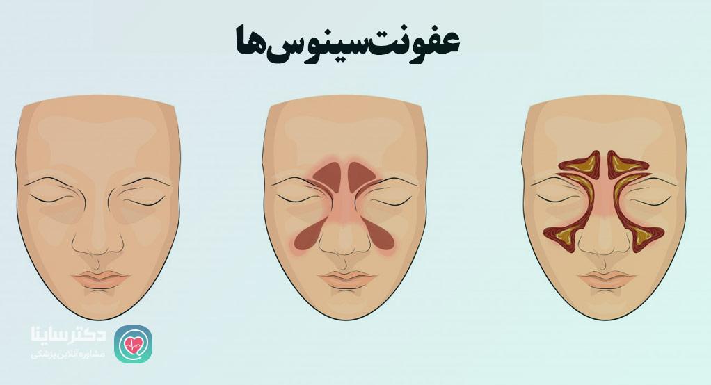 عفونت سینوس