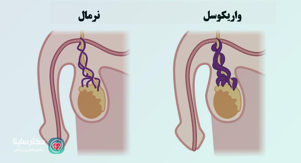 تصاویر واریکوسل
