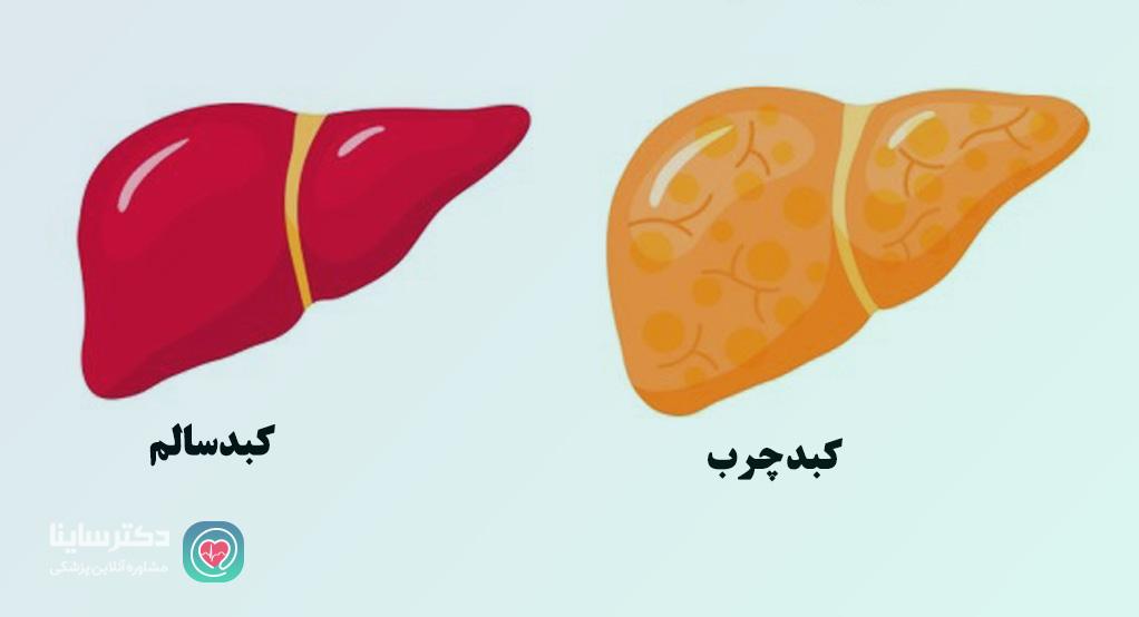 کبد چرب بارداری