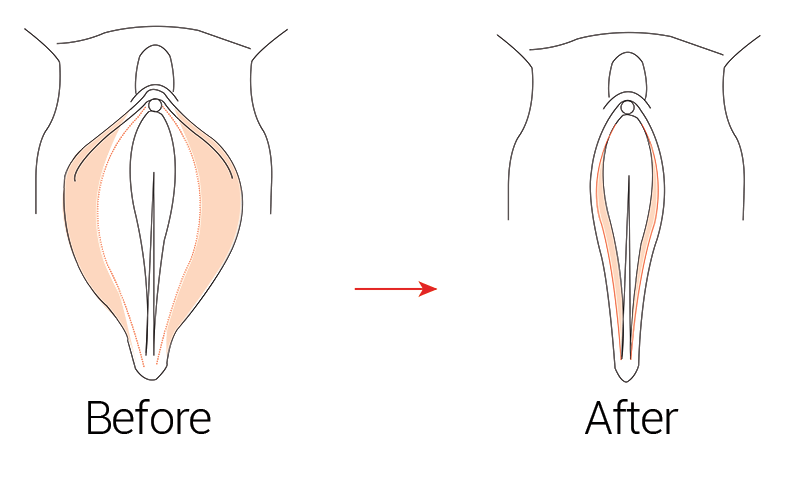 عمل تنگ کردن واژن