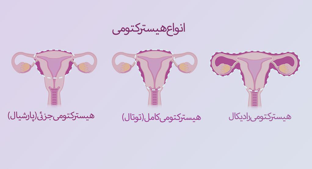 عمل هیسترکتومی
