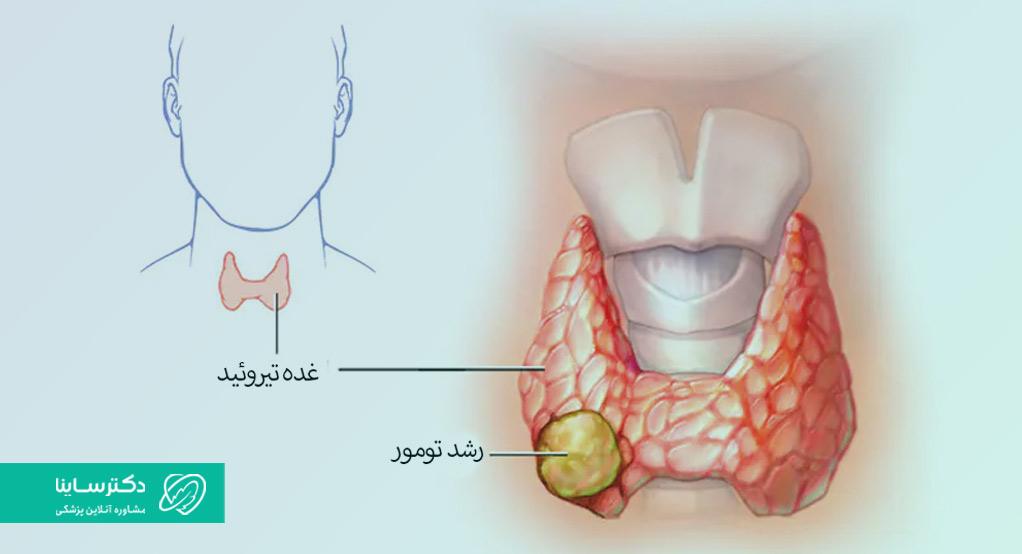 سرطان تیروئید بدخیم