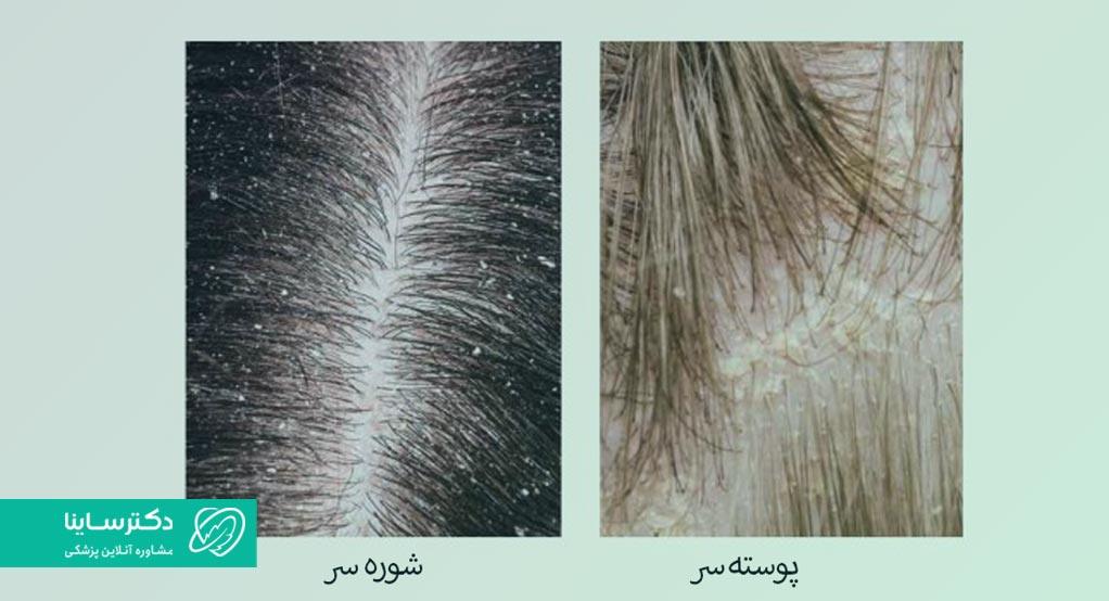 فرق شوره و پوسته سر