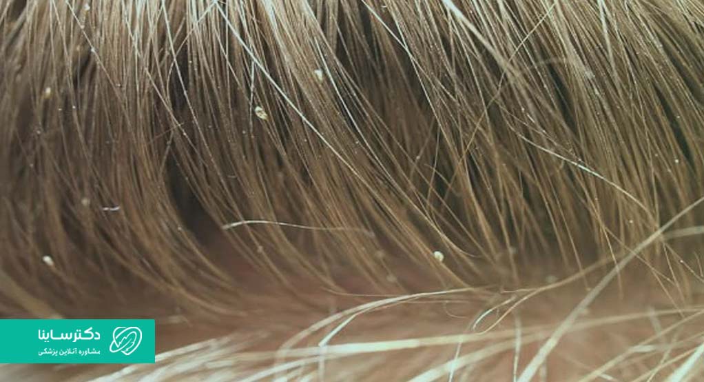 علائم شپش سر