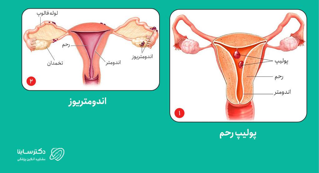 اندومتریوز و پولیپ رحم میتوانند باعث ترشحات غیرطبیعی قهوهای واژن شوند.