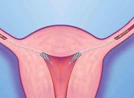 روش Essure یا استفاده از فنر در توبکتومی