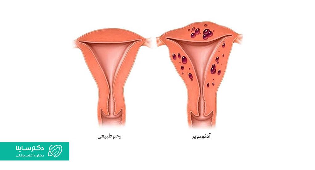 تفاوت رحم طبیعی با آدنومیوز در عکس مشخص شده است.