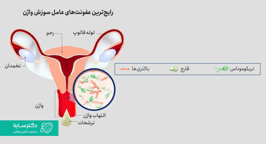 قارچ، باکتری و تریکوموناس از رایجترین علل سوزش واژن هستند.