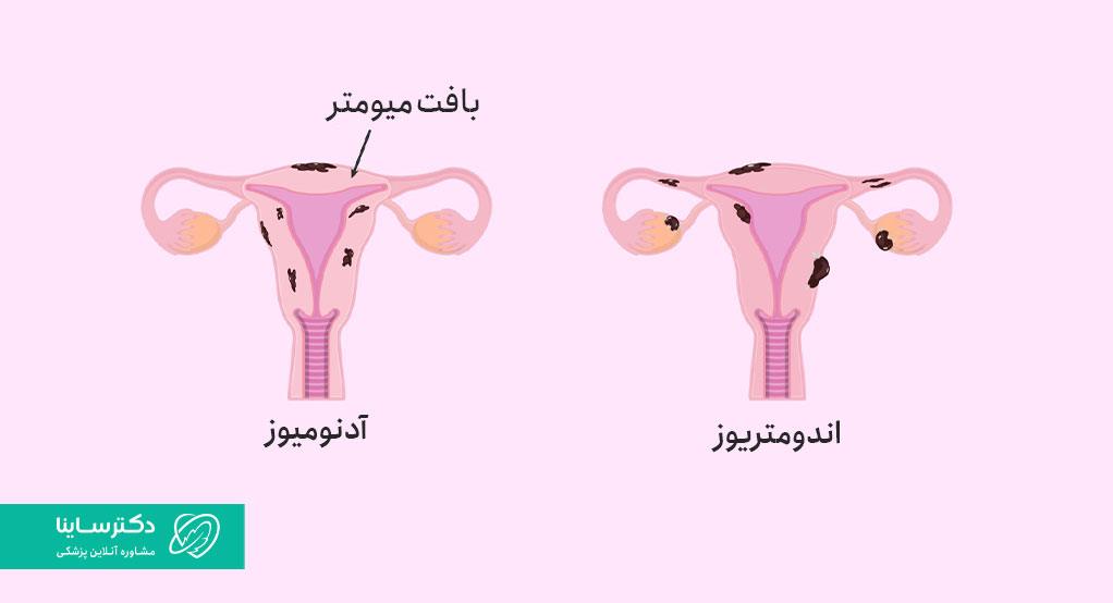 تفاوت اندومتریوز و آدنومیوز در عکس مشاهده میشود.
