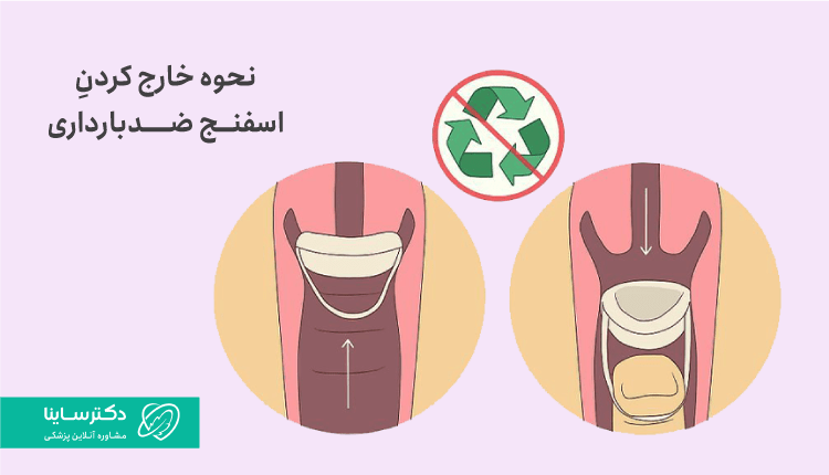 نحوه خارج کردن اسفنج ضدبارداری