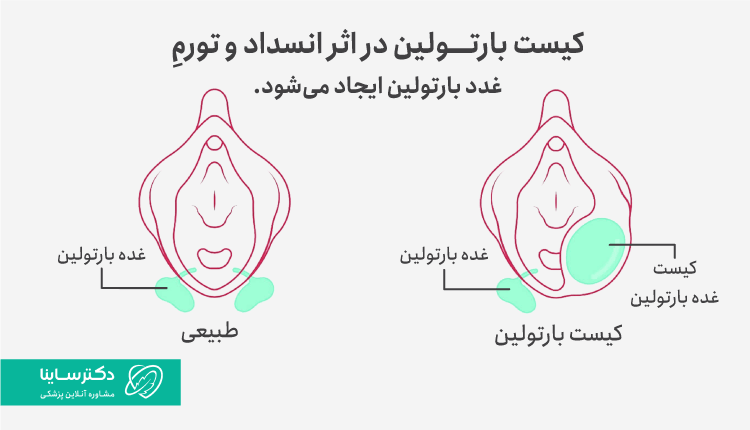محل کیست بارتولین