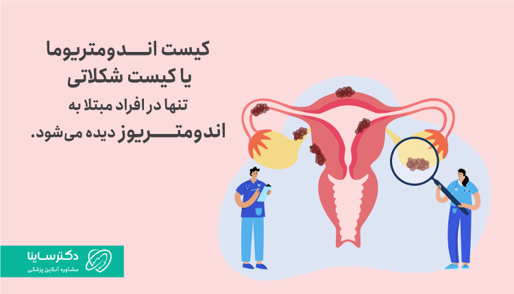 کیست اندومترویوما در افراد مبتلا به اندومتریوز دیده میشود.