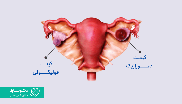 تفاوت کیست هموراژیک و کیست فولیکولی