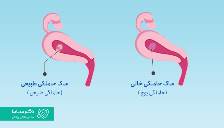تفاوت ساک حاملگی طبیعی و ساک حاملگی پوچ