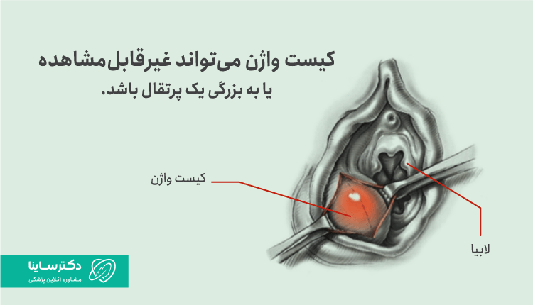 تصوویر کیست واژن و محل بهوجود آمدن آن