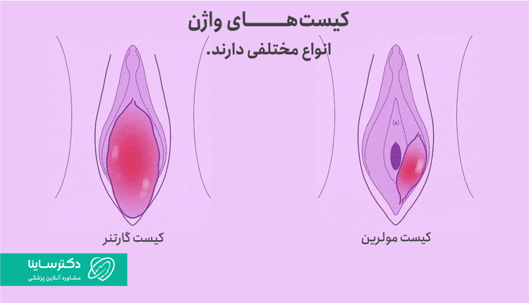 انواع مختلف کیست واژن