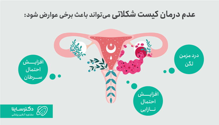 عوارض کیست شکلاتی