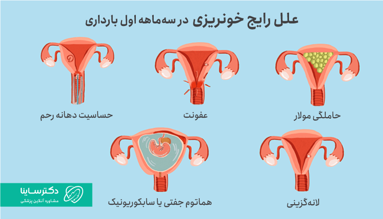 هلل خونریزی در سه ماهه اول بارداری