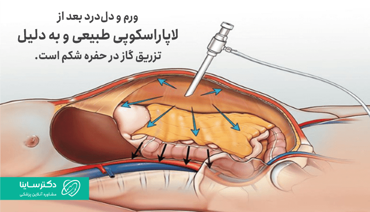 دل درد بعد از عمل کیست تخمدان طبیعی است.