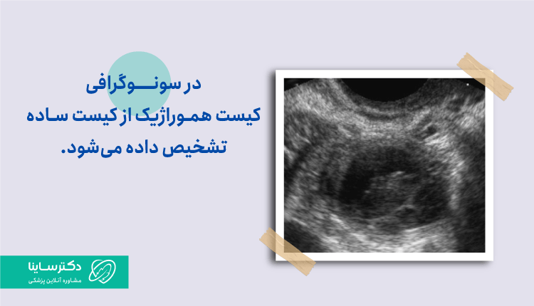 عکس کیست هموراژیک در سونوگرافی