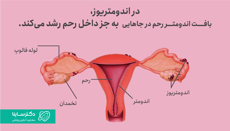 در اندومتریوز، بافت اندومتر در جاهایی به جز داخل رحم رشد میکند.