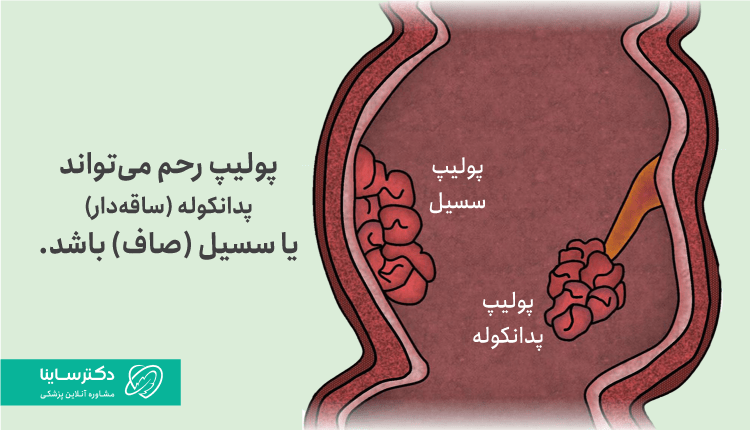 انواع پولیپ رحم