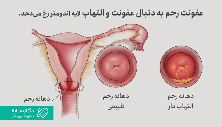 علت عفونت رحم