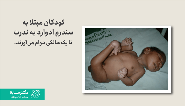 سندرم ادوارد یا تریزومی ۱۸