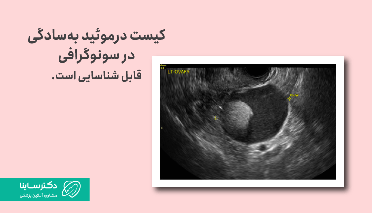 عکس کیست درموئید در سونوگرافی