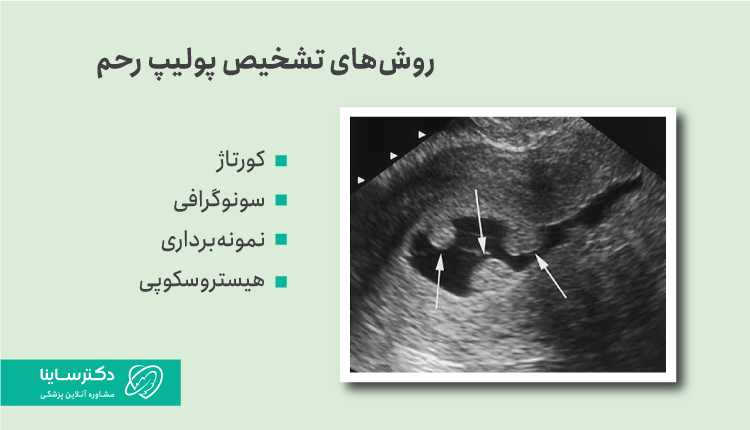 روش تشخیص پولیپ رحم