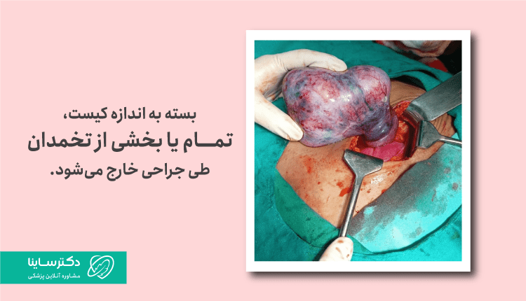 جراحی کیست درموئید تخمدان