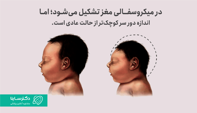 تفاوت میکروسفالی جنین با آنانسفالی