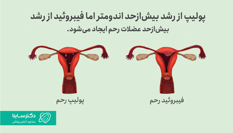 تفاوت پولیپ رحم و فیبروئید رحم