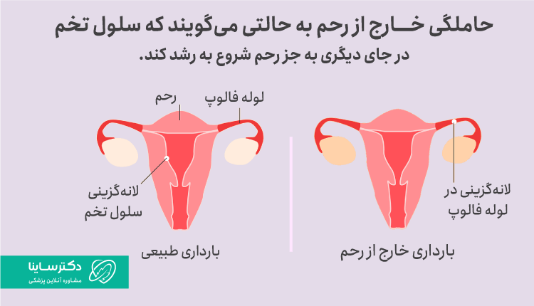 حاملگی خارج از رحم چیست