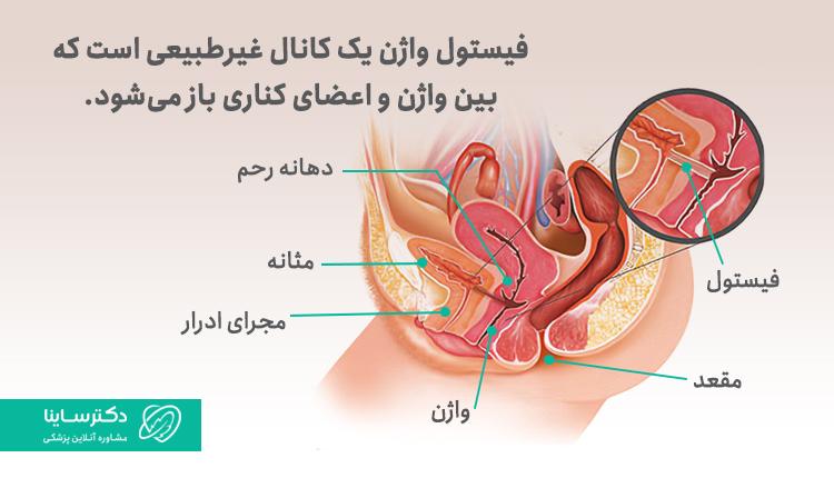 فیستول واژن یک کانال غیرطبیعی است که بین واژن و اعضای کناری باز میشود.