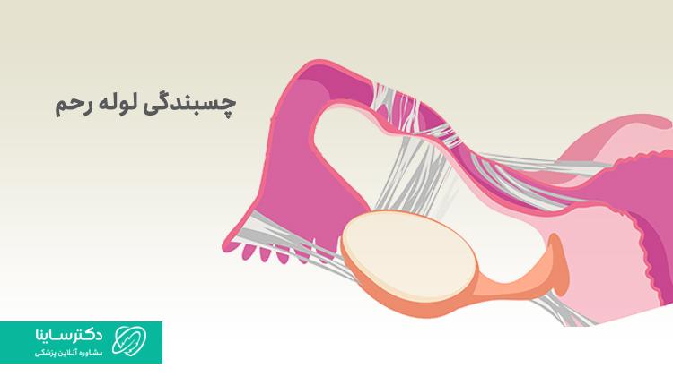 چسبندگی لوله رحم