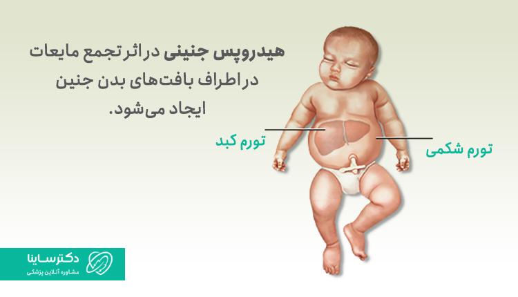 هیدروپس جنینی