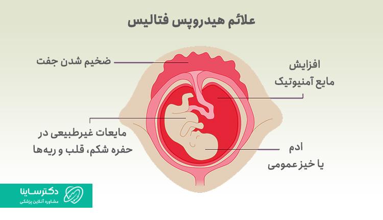 علائم هیدروپس فتالیس