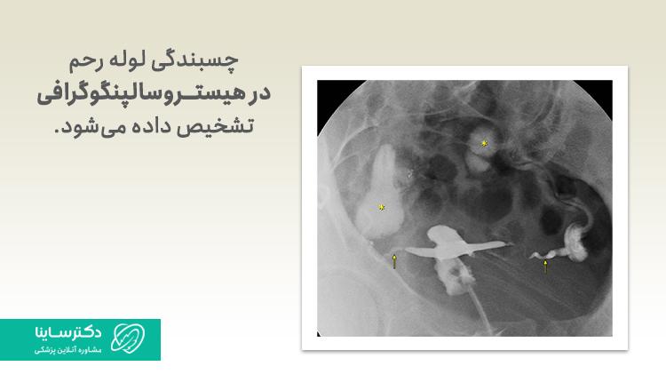 چسبندگی لوله رحم در هیستروسالپنگوگرافی