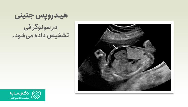 از طریق سونوگرافی هیدروپس جنین تشخیص داده میشود.