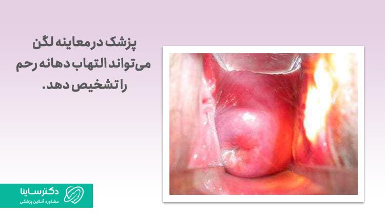 عکس سرویسیت یا التهاب دهانه رحم