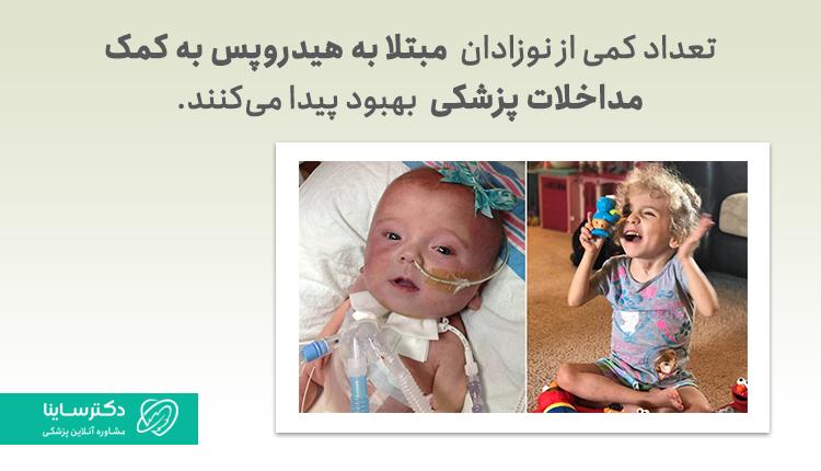 درمان هیدروپس جنینی یا هیدروپس فتالیس