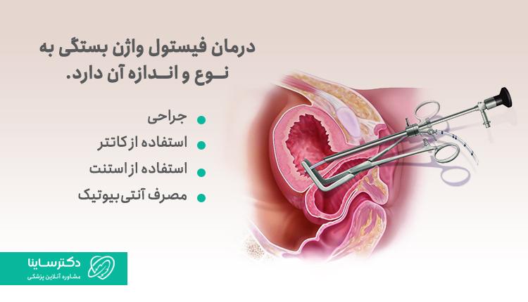 روشهای درمان فیستول واژن
