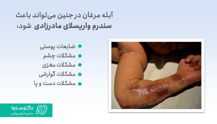 آبله مرغان در جنین میتواند باعث سندروم واریسلای مادرزادی شود.